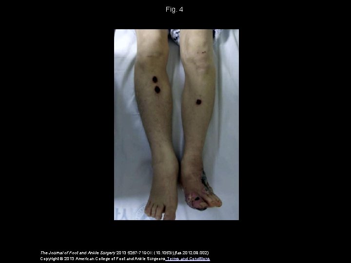Fig. 4 The Journal of Foot and Ankle Surgery 2013 5267 -71 DOI: (10.