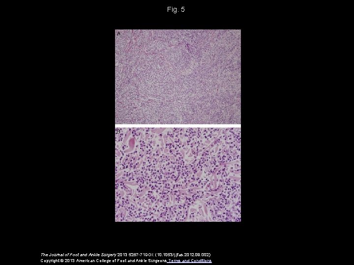 Fig. 5 The Journal of Foot and Ankle Surgery 2013 5267 -71 DOI: (10.