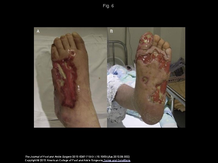 Fig. 6 The Journal of Foot and Ankle Surgery 2013 5267 -71 DOI: (10.