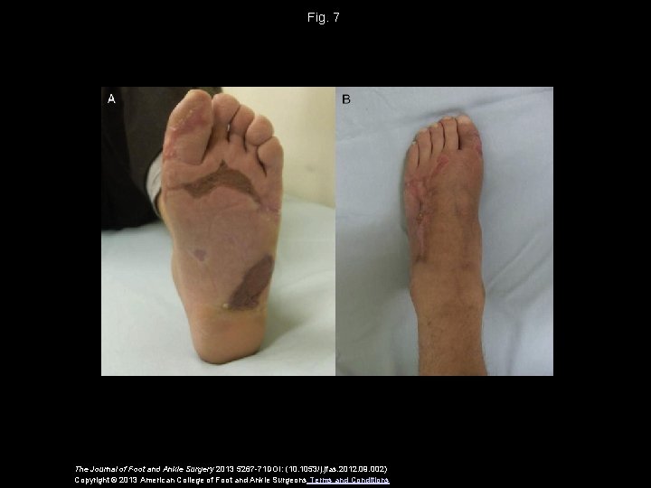 Fig. 7 The Journal of Foot and Ankle Surgery 2013 5267 -71 DOI: (10.