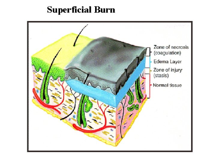Superficial Burn 