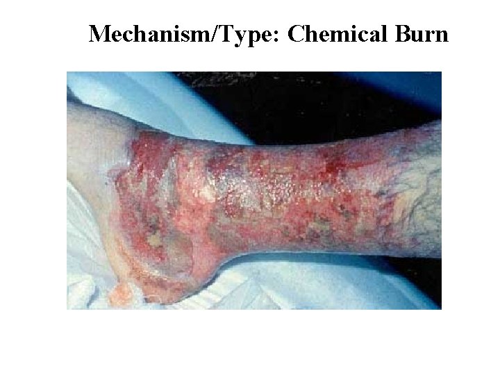 Mechanism/Type: Chemical Burn 