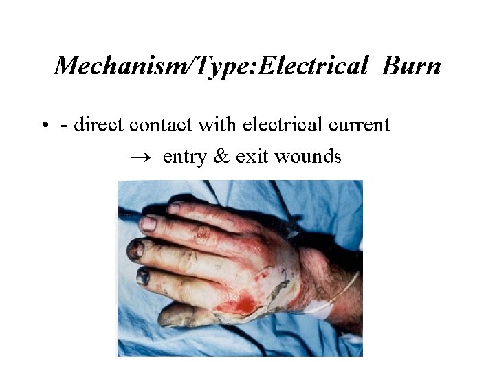 Mechanism/Type: Electrical Burn • - direct contact with electrical current ® entry & exit