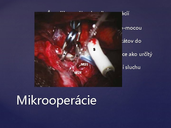  Častejšie používanie mikrooperácií Mikrosonda (napr. cez žilu) Zariadenia riadi priamo lekár po mocou