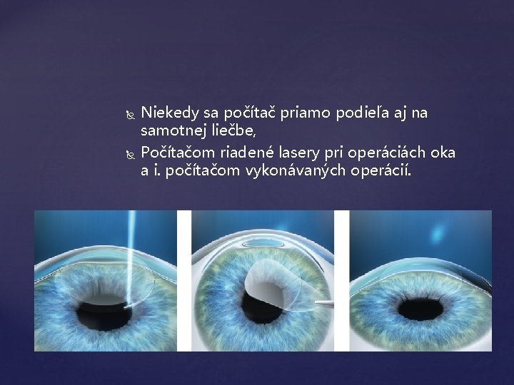  Niekedy sa počítač priamo podieľa aj na samotnej liečbe, Počítačom riadené lasery pri