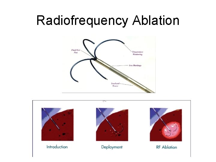 Radiofrequency Ablation 