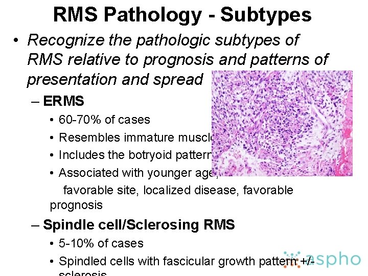 RMS Pathology - Subtypes • Recognize the pathologic subtypes of RMS relative to prognosis