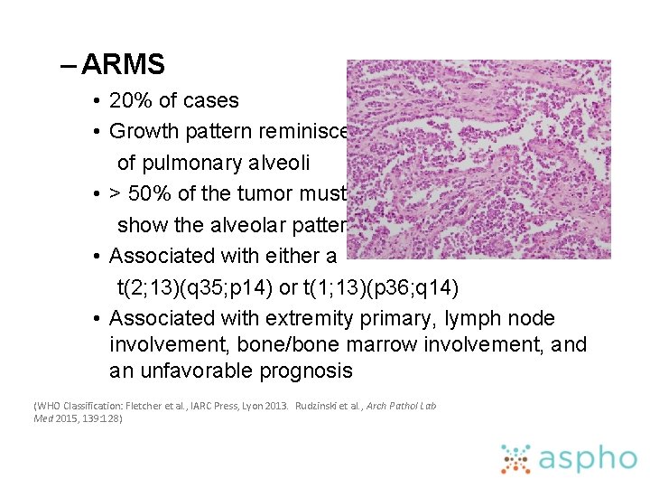 – ARMS • 20% of cases • Growth pattern reminiscent of pulmonary alveoli •