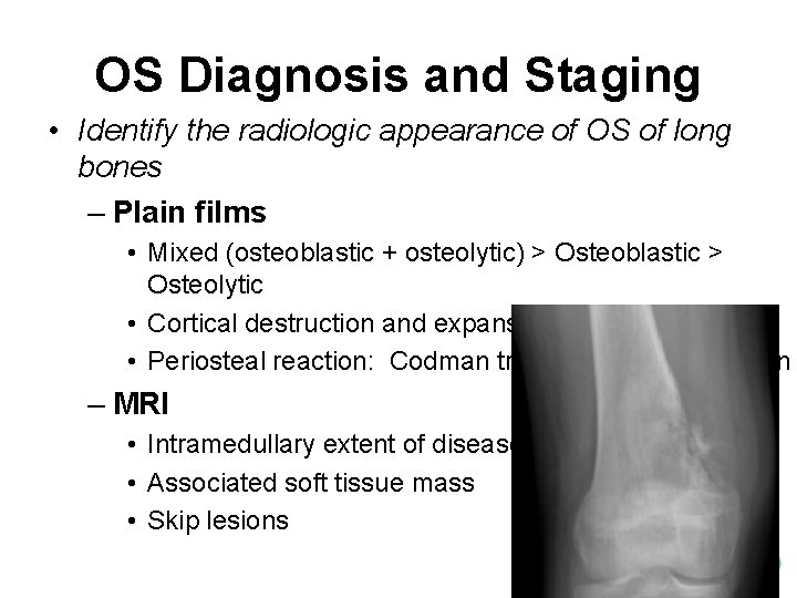 OS Diagnosis and Staging • Identify the radiologic appearance of OS of long bones