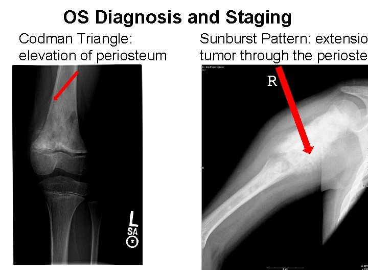 OS Diagnosis and Staging Codman Triangle: elevation of periosteum Sunburst Pattern: extensio tumor through