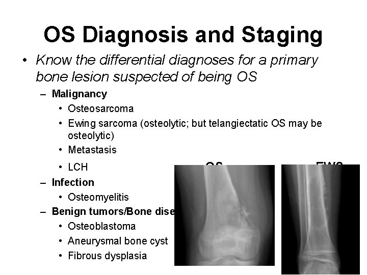 OS Diagnosis and Staging • Know the differential diagnoses for a primary bone lesion