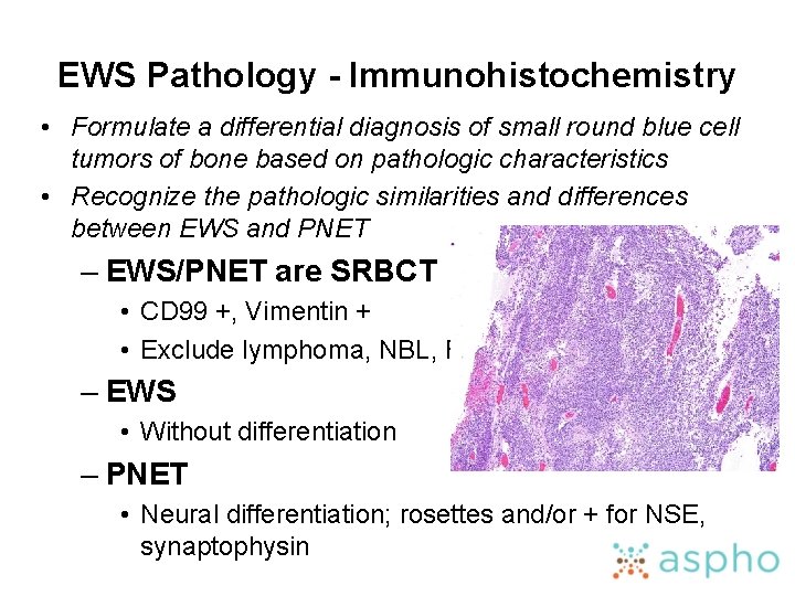 EWS Pathology - Immunohistochemistry • Formulate a differential diagnosis of small round blue cell