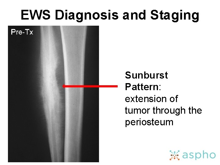 EWS Diagnosis and Staging Sunburst Pattern: extension of tumor through the periosteum 