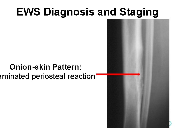EWS Diagnosis and Staging Onion-skin Pattern: aminated periosteal reaction 
