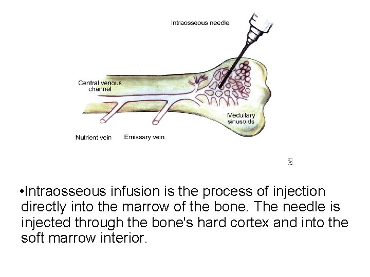  • Intraosseous infusion is the process of injection directly into the marrow of