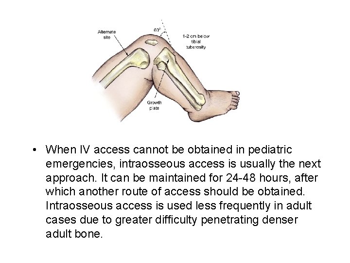  • When IV access cannot be obtained in pediatric emergencies, intraosseous access is