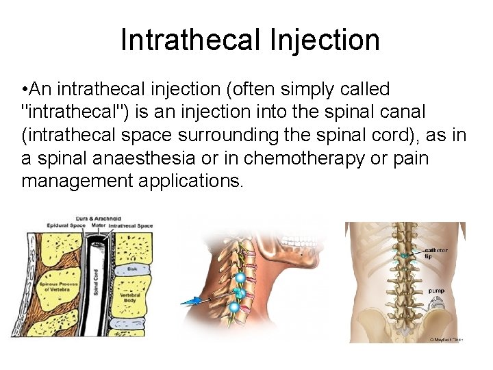 Intrathecal Injection • An intrathecal injection (often simply called "intrathecal") is an injection into
