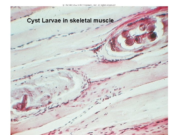 Figure 11. 13 (b) Cyst Larvae in skeletal muscle 