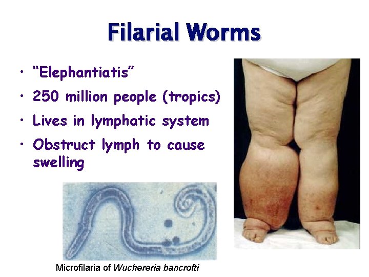 Filarial Worms • “Elephantiatis” • 250 million people (tropics) • Lives in lymphatic system