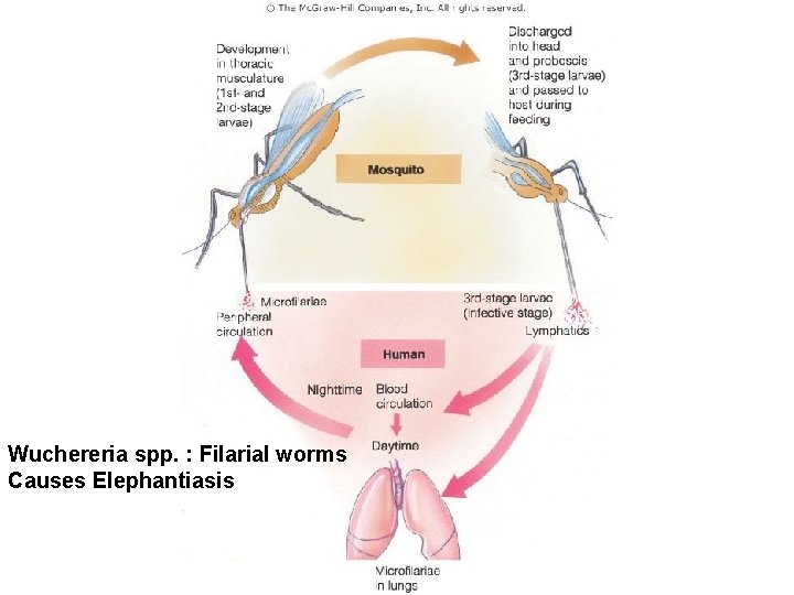 Figure 11. 15 Wuchereria spp. : Filarial worms Causes Elephantiasis 