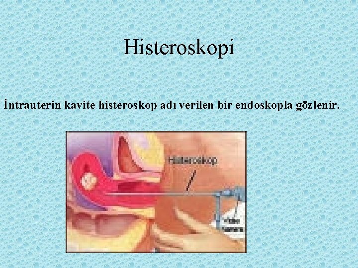 Histeroskopi İntrauterin kavite histeroskop adı verilen bir endoskopla gözlenir. 