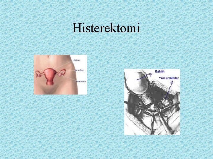 Histerektomi 