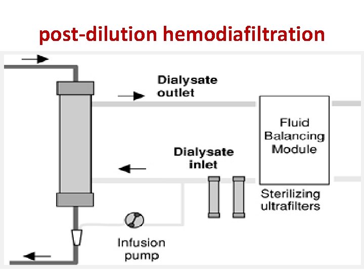 post-dilution hemodiafiltration 