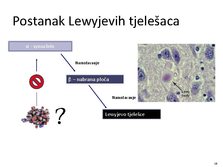 Postanak Lewyjevih tjelešaca α - synuclein Namotavanje β – nabrana ploča ? Namotavanje Lewyjevo