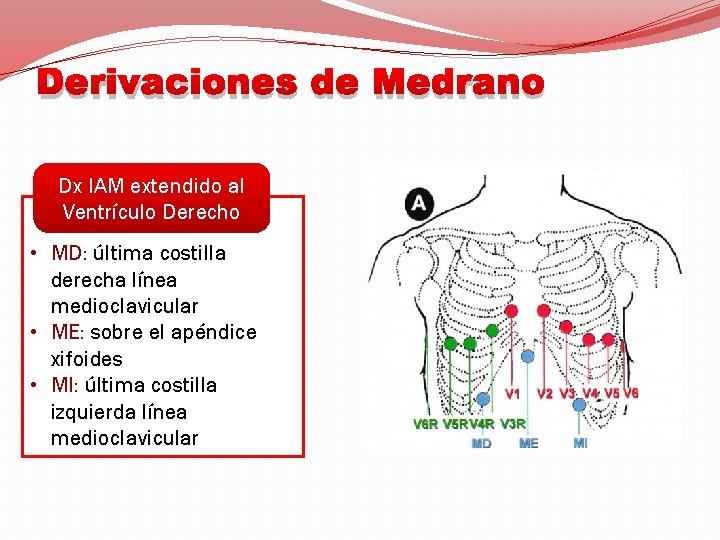Derivaciones de Medrano Dx IAM extendido al Ventrículo Derecho • MD: última costilla derecha
