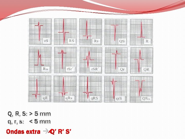 Q, R, S: > 5 mm q, r, s: < 5 mm Ondas extra
