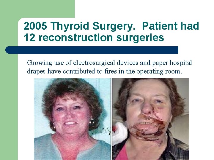 2005 Thyroid Surgery. Patient had 12 reconstruction surgeries Growing use of electrosurgical devices and