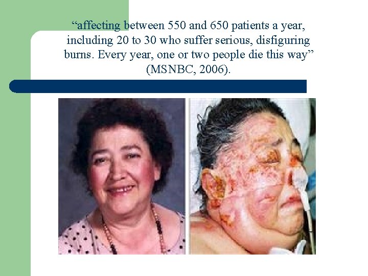“affecting between 550 and 650 patients a year, including 20 to 30 who suffer