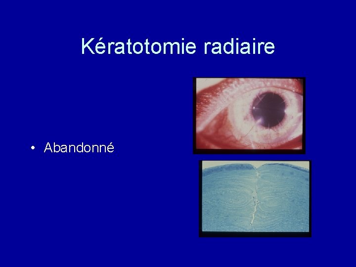 Kératotomie radiaire • Abandonné 