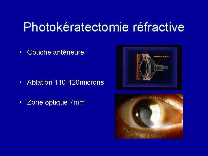 Photokératectomie réfractive • Couche antérieure • Ablation 110 -120 microns • Zone optique 7
