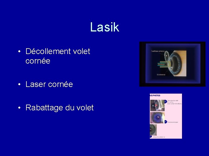 Lasik • Décollement volet cornée • Laser cornée • Rabattage du volet 