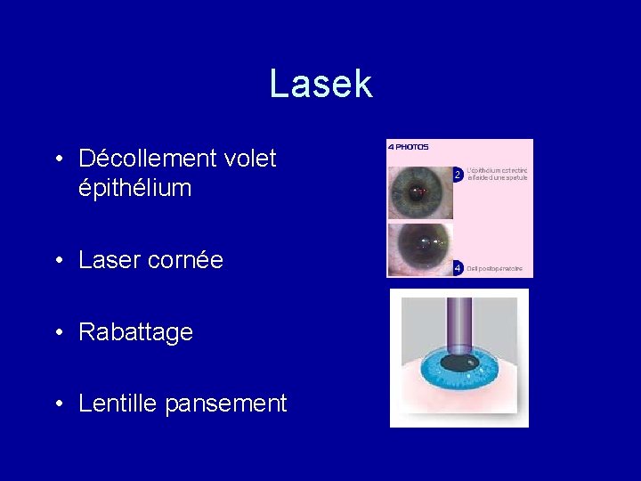 Lasek • Décollement volet épithélium • Laser cornée • Rabattage • Lentille pansement 