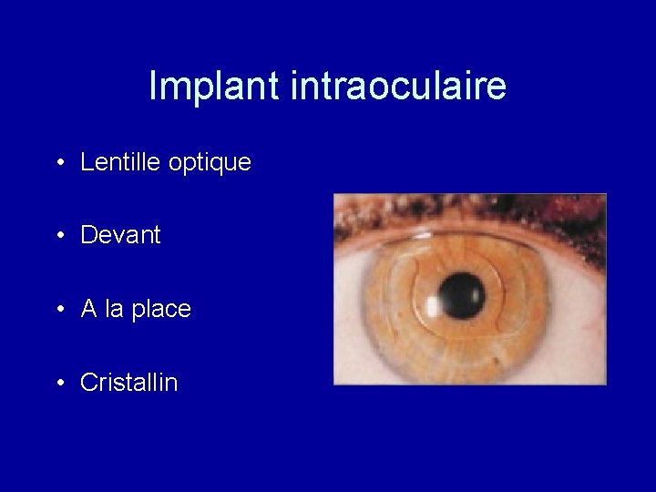 Implant intraoculaire • Lentille optique • Devant • A la place • Cristallin 