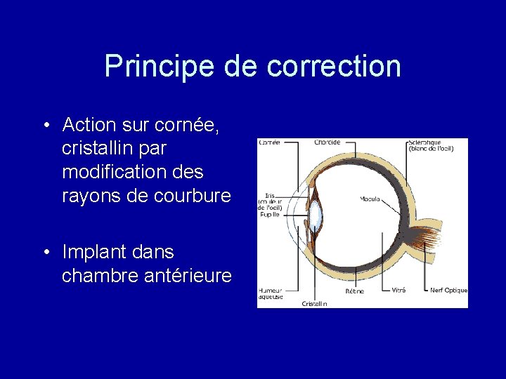 Principe de correction • Action sur cornée, cristallin par modification des rayons de courbure