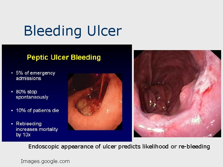 Bleeding Ulcer Endoscopic appearance of ulcer predicts likelihood or re-bleeding Images. google. com 