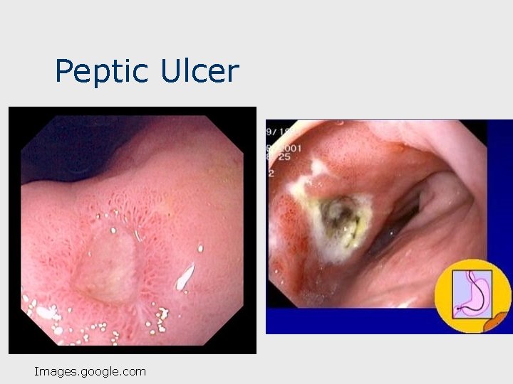 Peptic Ulcer Images. google. com 