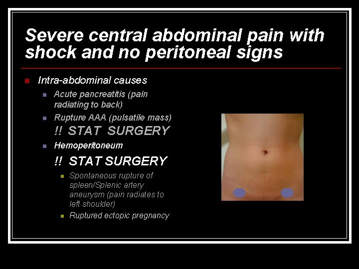 Severe central abdominal pain with shock and no peritoneal signs n Intra-abdominal causes n