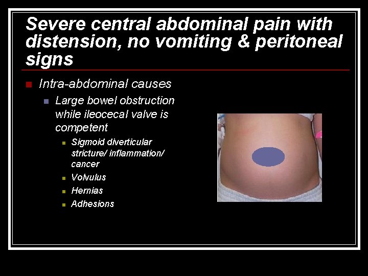 Severe central abdominal pain with distension, no vomiting & peritoneal signs n Intra-abdominal causes