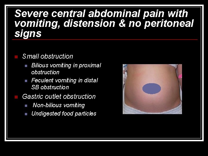 Severe central abdominal pain with vomiting, distension & no peritoneal signs n Small obstruction