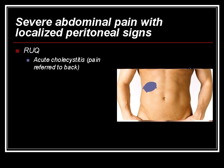 Severe abdominal pain with localized peritoneal signs n RUQ n Acute cholecystitis (pain referred
