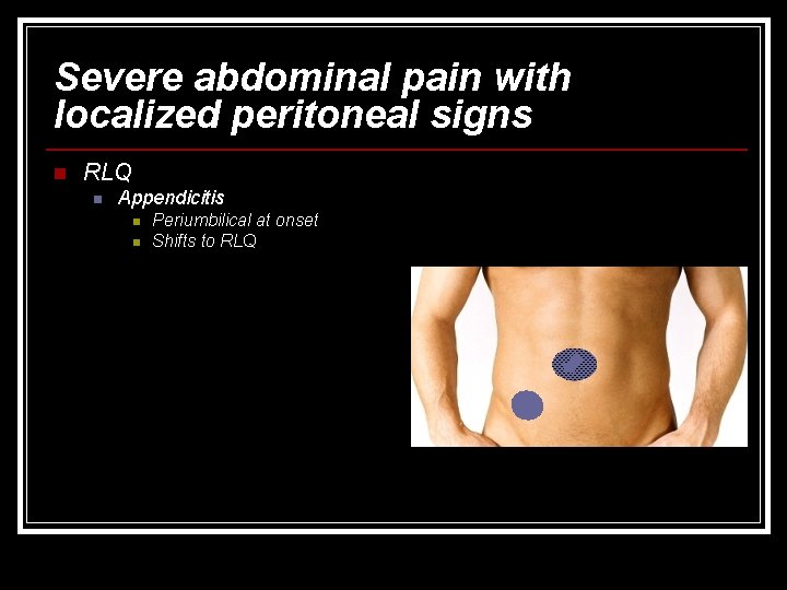 Severe abdominal pain with localized peritoneal signs n RLQ n Appendicitis n n Periumbilical