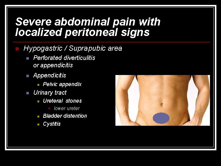 Severe abdominal pain with localized peritoneal signs n Hypogastric / Suprapubic area n Perforated