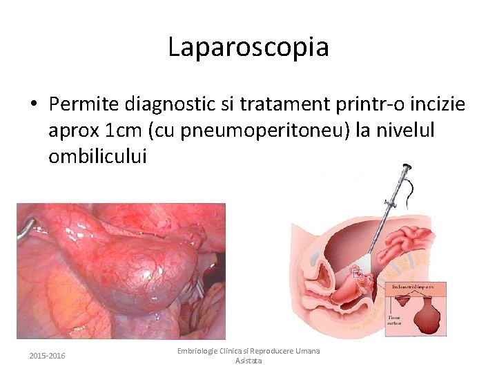 Laparoscopia • Permite diagnostic si tratament printr-o incizie aprox 1 cm (cu pneumoperitoneu) la