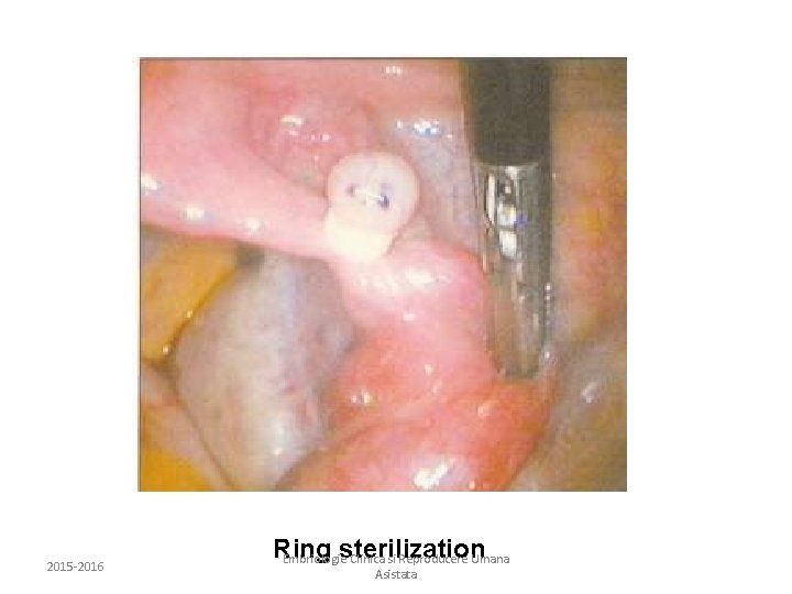 2015 -2016 Ring sterilization Embriologie Clinica si Reproducere Umana Asistata 