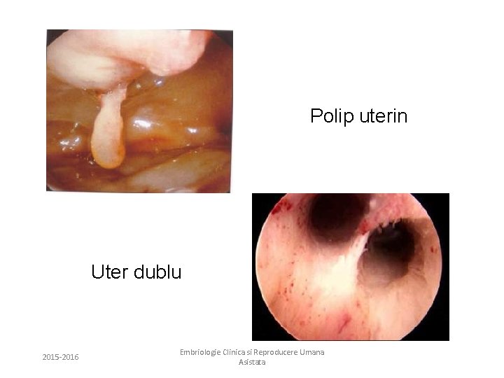 Polip uterin Uter dublu 2015 -2016 Embriologie Clinica si Reproducere Umana Asistata 