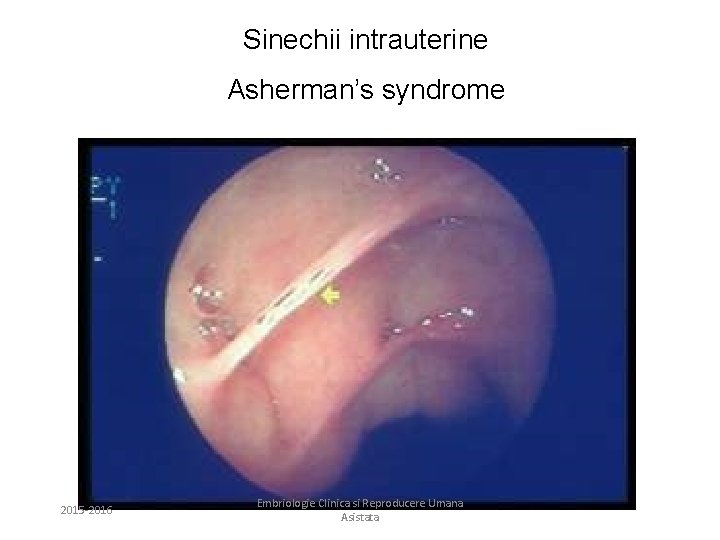Sinechii intrauterine Asherman’s syndrome 2015 -2016 Embriologie Clinica si Reproducere Umana Asistata 